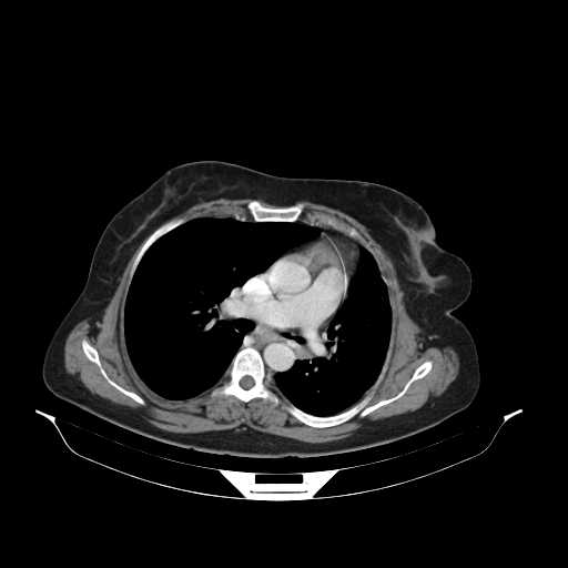 File:Carotid body tumor (Radiopaedia 21021-20948 B 38).jpg