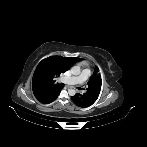 File:Carotid body tumor (Radiopaedia 21021-20948 B 39).jpg