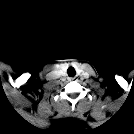 File:Carotid body tumor (Radiopaedia 27890-28124 A 23).jpg