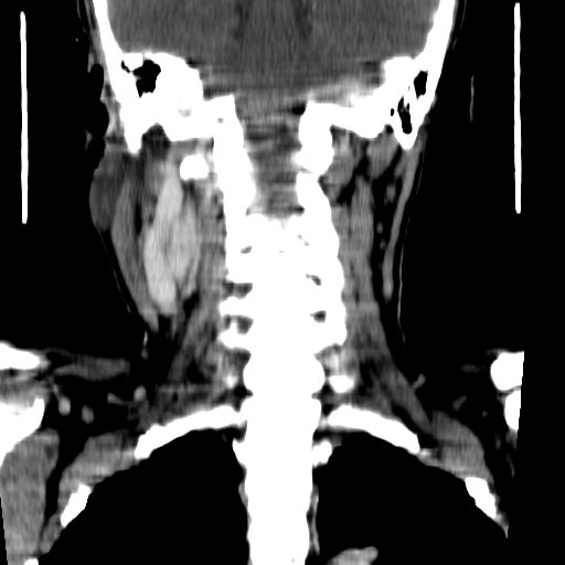 File:Carotid body tumor (Radiopaedia 27890-28124 B 4).jpg