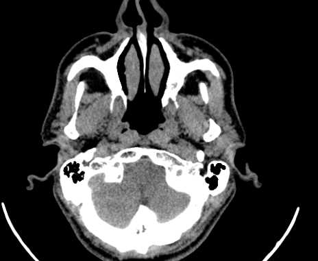 Carotid body tumor (Radiopaedia 61750-69757 Axial non-contrast 1).jpg