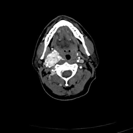 File:Carotid body tumor (Radiopaedia 83615-98727 A 47).jpg