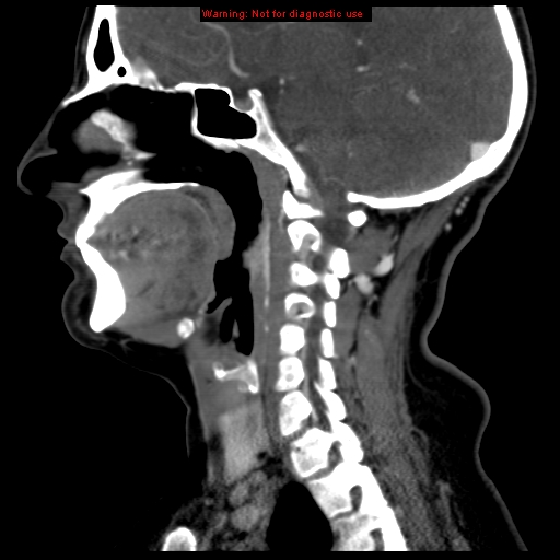 File:Carotid body tumor with lung metastases (Radiopaedia 9301-9986 Sagittal C+ delayed 23).jpg