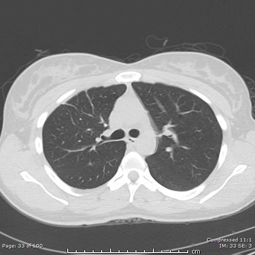 Catamenial pneumothorax (Radiopaedia 54382-60600 Axial non-contrast 33).jpg