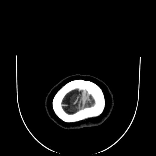 Cavernoma with developmental venous anomaly (Radiopaedia 22470-22506 C 199).jpg