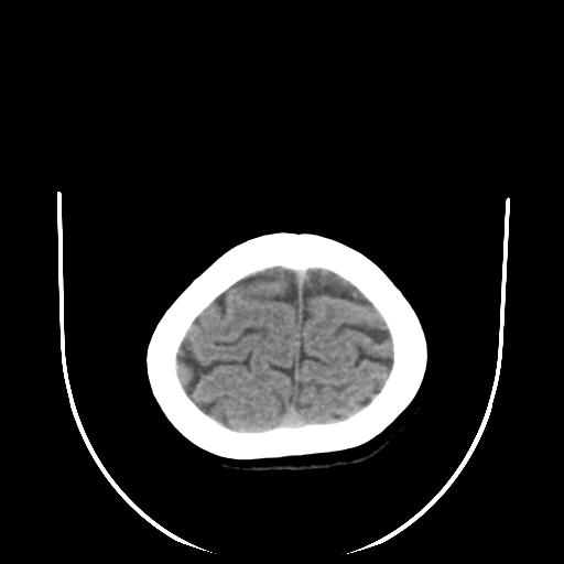 File:Cavernoma with developmental venous anomaly (Radiopaedia 22470-22506 non-contrast 31).jpg