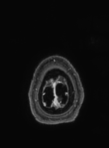 Cavernous hemangioma of the cerebellar falx (Radiopaedia 73025-83724 Axial T1 C+ 19).jpg