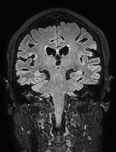 Cavernous hemangioma of the cerebellar falx (Radiopaedia 73025-83724 Coronal FLAIR 204).jpg