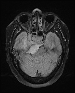 File:Cavernous sinus meningioma (Radiopaedia 63682-72367 Axial FLAIR 8).jpg