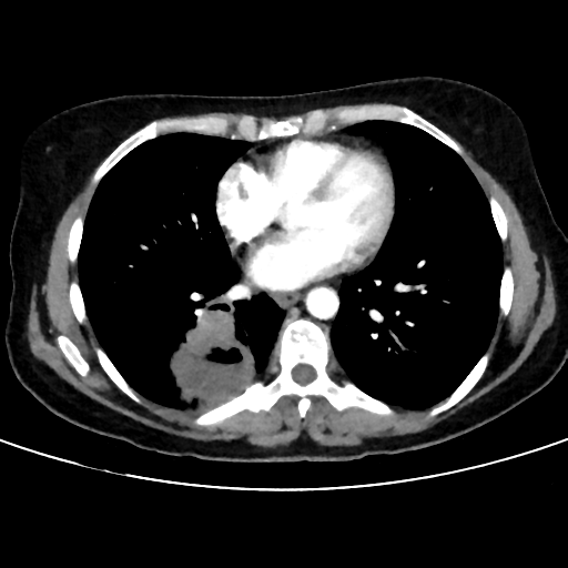 File:Cavitating lung mass - squamous cell carcinoma (Radiopaedia 48047-52854 B 30).png