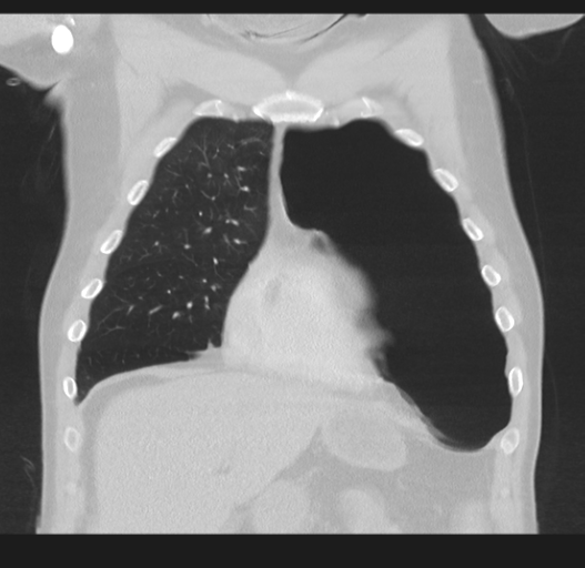 Cavitating pneumonia complicated by pneumothorax (Radiopaedia 48149-52994 Coronal lung window 17).png
