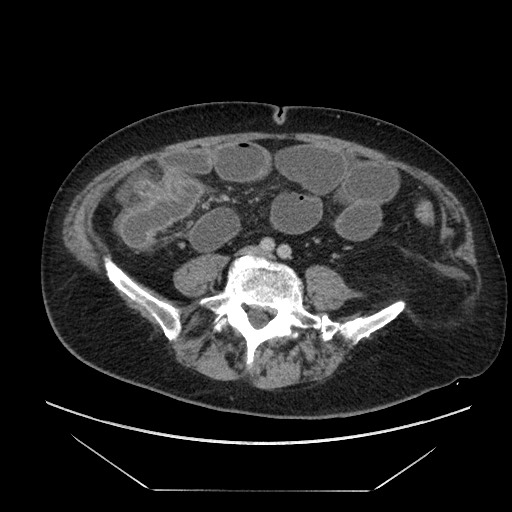 Cecal adenocarcinoma (Radiopaedia 64871-73817 A 62).jpg