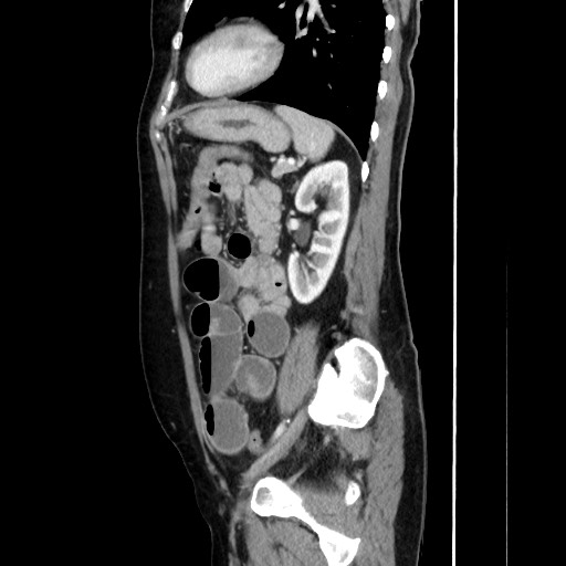 Cecal adenocarcinoma (Radiopaedia 75909-87331 C 50).jpg