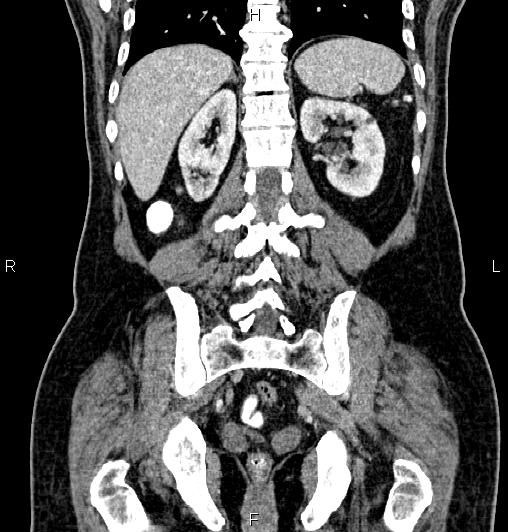 File:Cecal adenocarcinoma (Radiopaedia 85324-100916 D 49).jpg