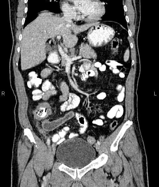 Cecal cancer with appendiceal mucocele (Radiopaedia 91080-108651 D 30).jpg