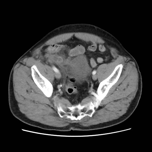 Cecal mass causing appendicitis (Radiopaedia 59207-66531 A 73).jpg