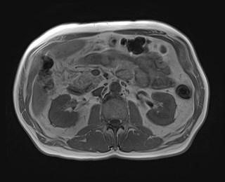 File:Cecal mass causing appendicitis (Radiopaedia 59207-66532 Axial T1 in-phase 59).jpg