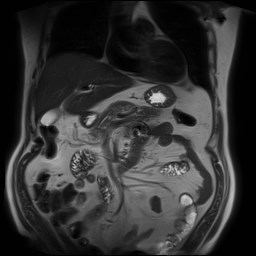 File:Cecal mass causing appendicitis (Radiopaedia 59207-66532 Coronal T2 14).jpg