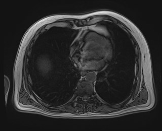Cecal mass causing appendicitis (Radiopaedia 59207-66532 D 11).jpg
