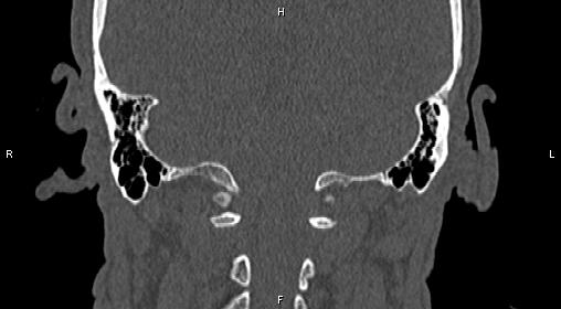 Central giant cell granuloma (Radiopaedia 83346-97761 Coronal bone window 39).jpg