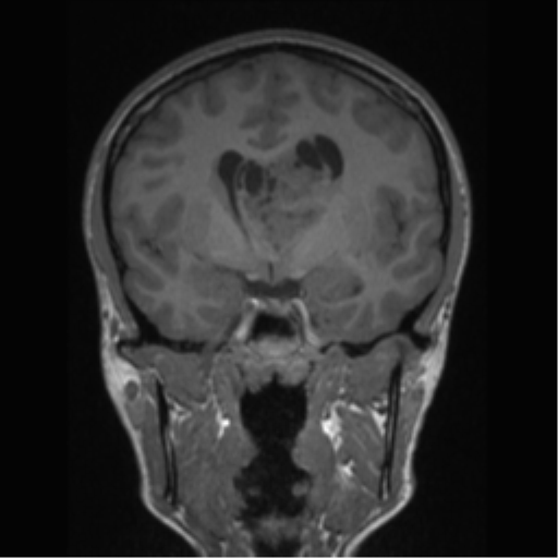 Central neurocytoma (Radiopaedia 37664-39557 Coronal T1 51).png