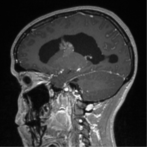 File:Central neurocytoma (Radiopaedia 37664-39557 Sagittal T1 C+ 38).png
