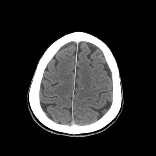 Central neurocytoma (Radiopaedia 68725-78432 Axial C+ 78).jpg