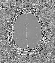 File:Central neurocytoma (Radiopaedia 84497-99872 Axial 57).jpg