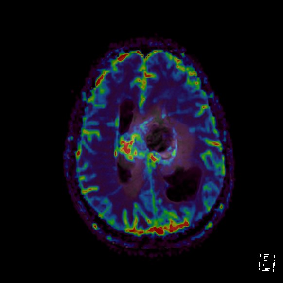 Central neurocytoma (Radiopaedia 84497-99872 Axial Perfusion 105).jpg
