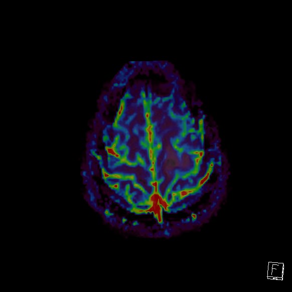 File:Central neurocytoma (Radiopaedia 84497-99872 Axial Perfusion 35).jpg