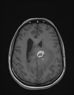 Central neurocytoma (Radiopaedia 84497-99872 Axial T1 132).jpg