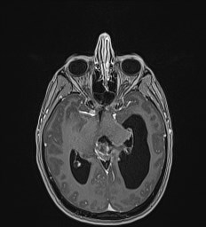 Central neurocytoma (Radiopaedia 84497-99872 Axial T1 C+ 67).jpg