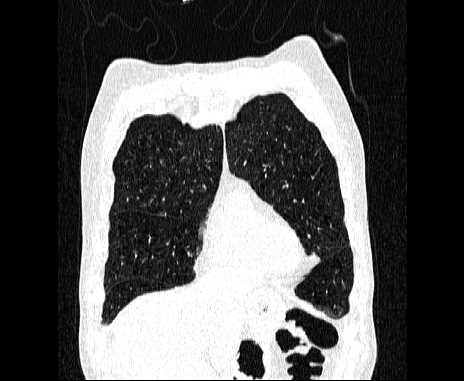 Centrilobular pulmonary emphysema (Radiopaedia 62468-70718 Coronal lung window 15).jpg