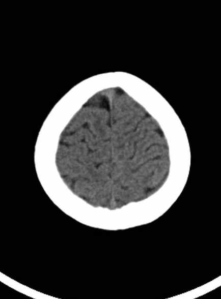 Cerebellar abscess (Radiopaedia 73727-84527 Axial non-contrast 58).jpg