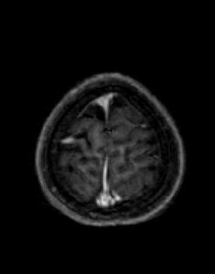 File:Cerebellar abscess (Radiopaedia 73727-84563 Axial T1 C+ fat sat 98).jpg