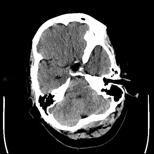 Cerebellar abscess (Radiopaedia 78135-90671 Axial non-contrast 29).jpg