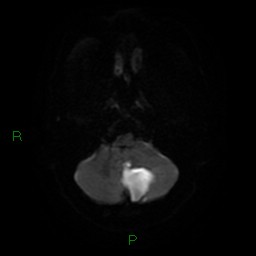 Cerebellar abscess (Radiopaedia 78135-90678 Axial DWI 7).jpg