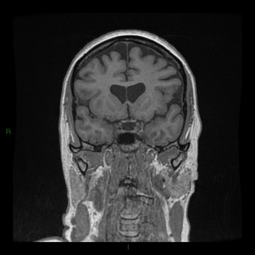Cerebellar abscess (Radiopaedia 78135-90678 Coronal T1 C+ 62).jpg