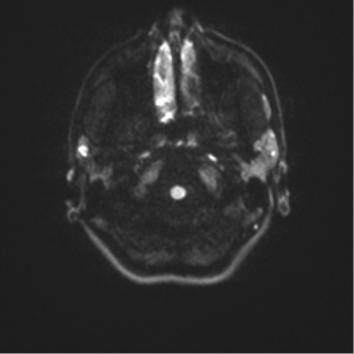 Cerebellar agenesis with hypoplastic pons (pontocerebellar hypoplasia) (Radiopaedia 57224-64138 Axial DWI 40).png