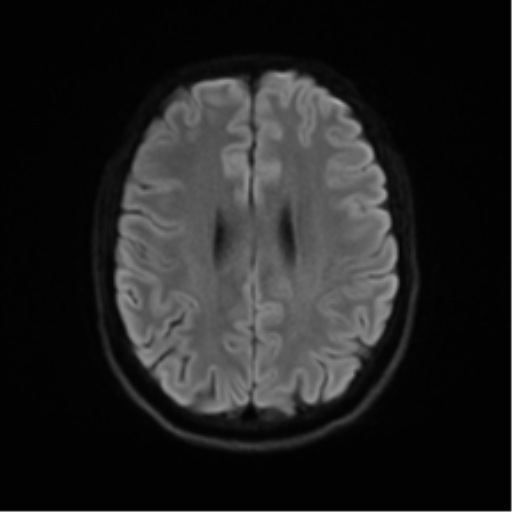 Cerebellar agenesis with hypoplastic pons (pontocerebellar hypoplasia) (Radiopaedia 57224-64138 Axial DWI 62).png