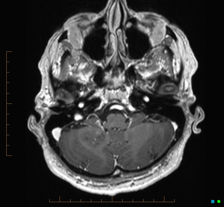 Cerebellar gangliocytoma (Radiopaedia 65377-74422 Axial T1 C+ 18).jpg