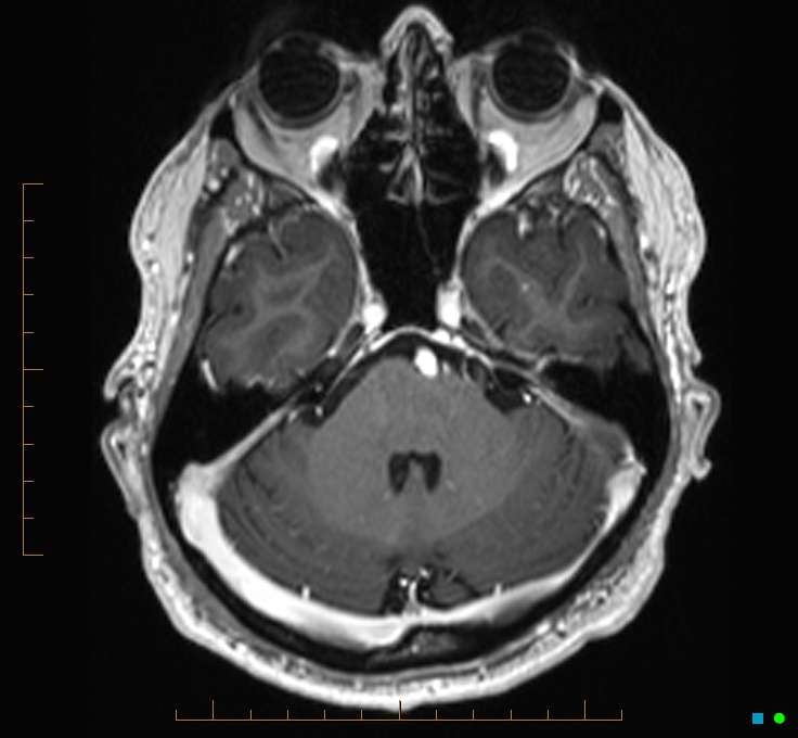 Cerebellar gangliocytoma (Radiopaedia 65377-74422 Axial T1 C+ 30).jpg