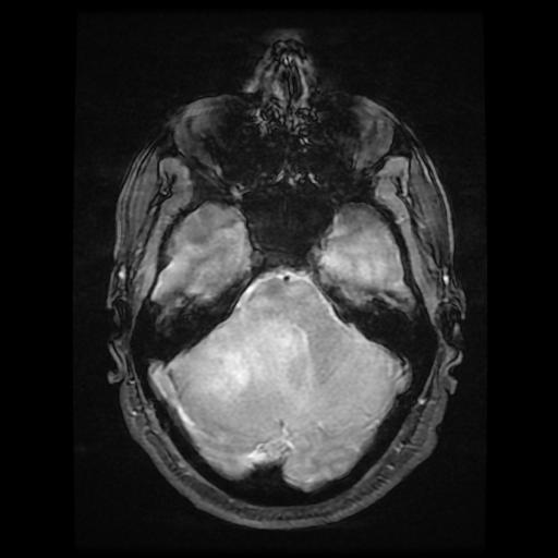 File:Cerebellar hemangioblastoma (Radiopaedia 88055-104622 Axial Gradient Echo 6).jpg