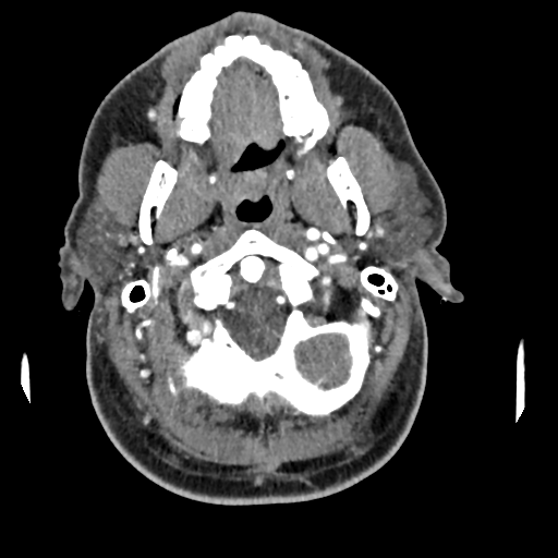 Cerebellar infarct due to vertebral artery dissection with posterior fossa decompression (Radiopaedia 82779-97029 C 52).png