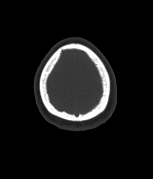 File:Cerebellar metastases - colorectal adenocarcinoma (Radiopaedia 40947-43652 AX Bone C- 2.0 MPR 60).png