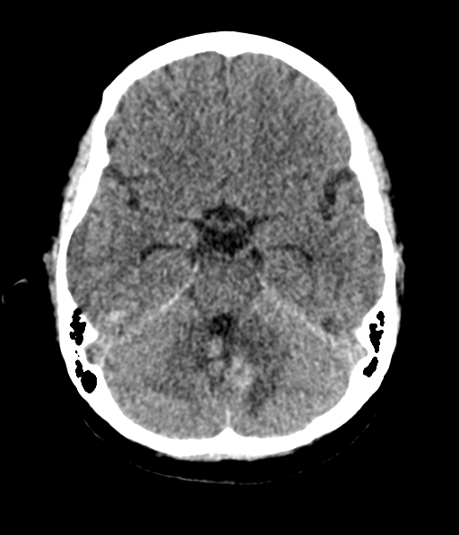 Cerebellar metastases - colorectal adenocarcinoma (Radiopaedia 40947-43652 Axial non-contrast 21).png
