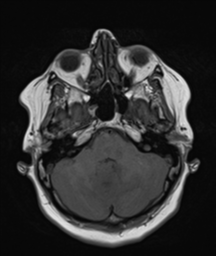 File:Cerebellar metastasis (Radiopaedia 54578-60810 Axial T1 9).png