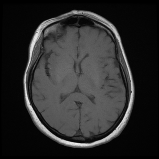File:Cerebellar metastasis (cystic appearance) (Radiopaedia 41395-44268 Axial T1 13).png