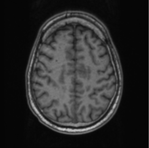 Cerebellar metastasis from lung adenocarcinoma (Radiopaedia 86690-102829 Axial T1 61).png