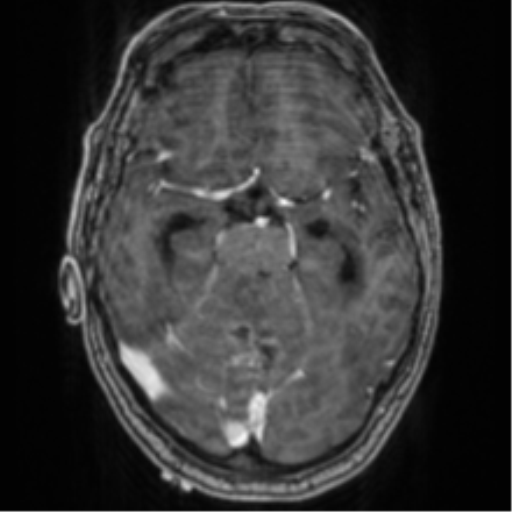 File:Cerebellar metastasis from lung adenocarcinoma (Radiopaedia 86690-102829 Axial T1 C+ 32).png